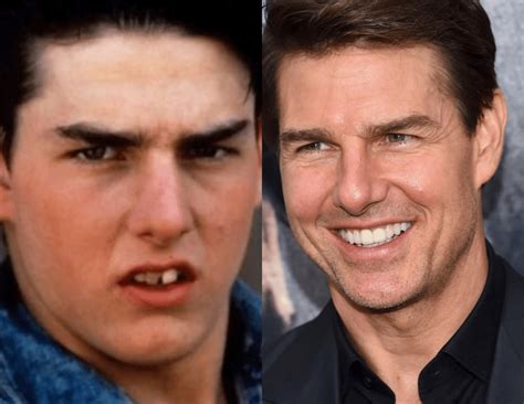 tom cruise teeth before